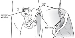 Bone graft sources 