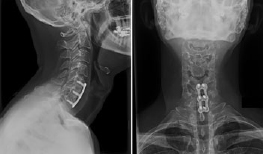 Anterior Cervical Discectomy and Fusion (ACDF)