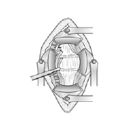 Anterior Lumbar Interbody Fusion