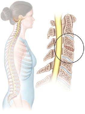 Anterior Cervical Fusion 