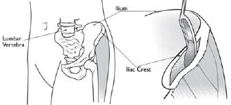 Lumbar Spinal Fusion