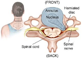 Cervical Radiculopathy