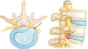 Herniated Disk