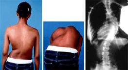 Idiopathic Scoliosis in Children and Adolescents