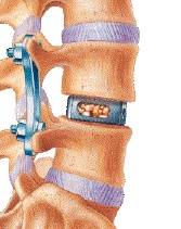 Intervertebral Cages