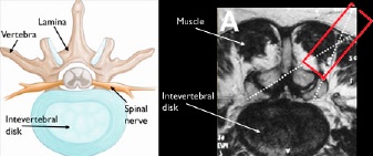 Intevertebral-disk