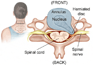 Neck Pain  X-ray