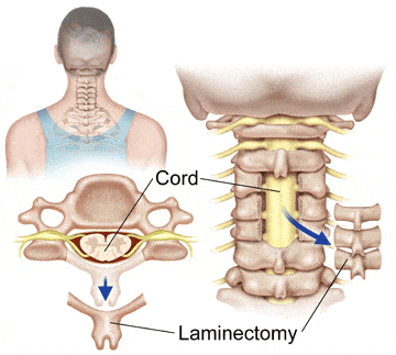 Laminectomy