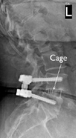 Lateral Lumbar Interbody Fusion