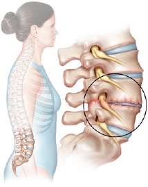 Lumbar Herniated Disc 