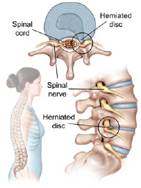 Lumbar Spinal Fusion