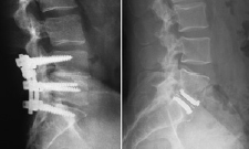 Lumbar Spinal Fusion