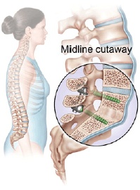 Lumbar Spinal Fusion