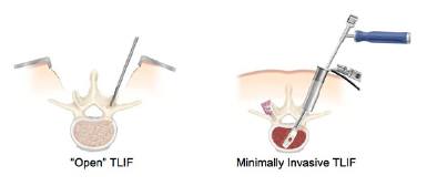 Intevertebral-disk