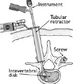 Intevertebral-disk