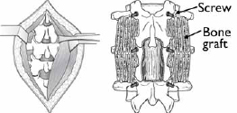 Minimally Invasive Spine Surgery