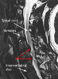 MRI Scan