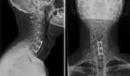 Cervical Spondylotic Myelopathy -Anterior Approach 