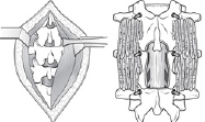 Cervical Spondylotic Myelopathy -Laminectomy 