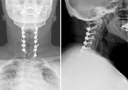 Cervical Spondylotic Myelopathy -Laminectomy 