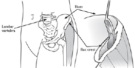 Cervical Spondylotic Myelopathy 