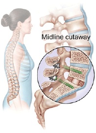 Pedicle Screws and Rods 