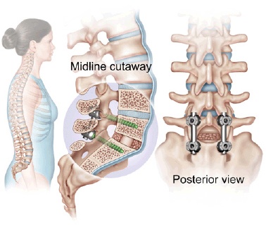 Pedicle Screws and Rods 