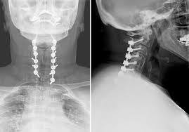 Posterior Cervical Fusion