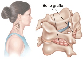 Posterior Cervical Fusion