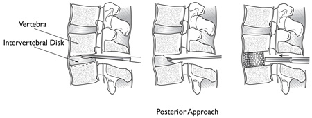 Posterior lumbar interbody fusion