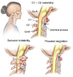 Rheumatoid Arthritis