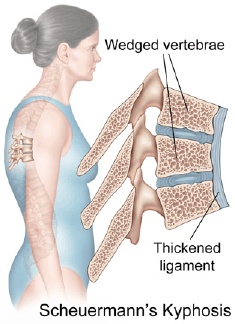 Scheuermann's Kyphosis 