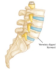 Slipped Vertebra 