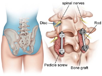 Transforaminal lumbar interbody fusion (TLIF)