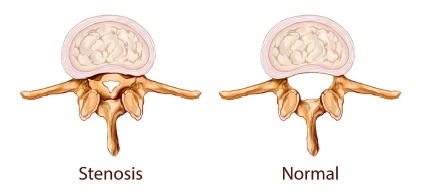 Spinal stenosis 