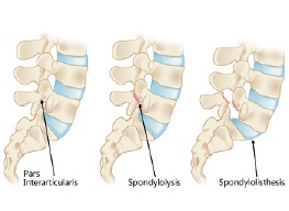 Spondylolisthesis 