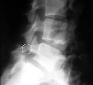 Spondylolysis and Spondylolisthesis Imaging Test 