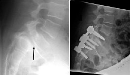 Spondylolysis and Spondylolisthesis Imaging Test 