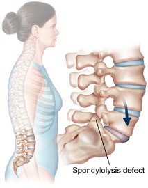 Spondylolysis and Spondylolisthesis 