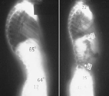 Mild Kyphosis