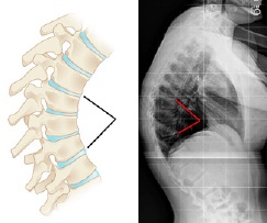 Vertebrae