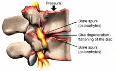 Neck Pain  X-ray