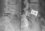 Anterior Lumbar Interbody Fusion