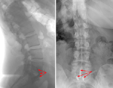 Anterior Lumbar Interbody Fusion