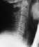 Cervical Stenosis Diagnosis